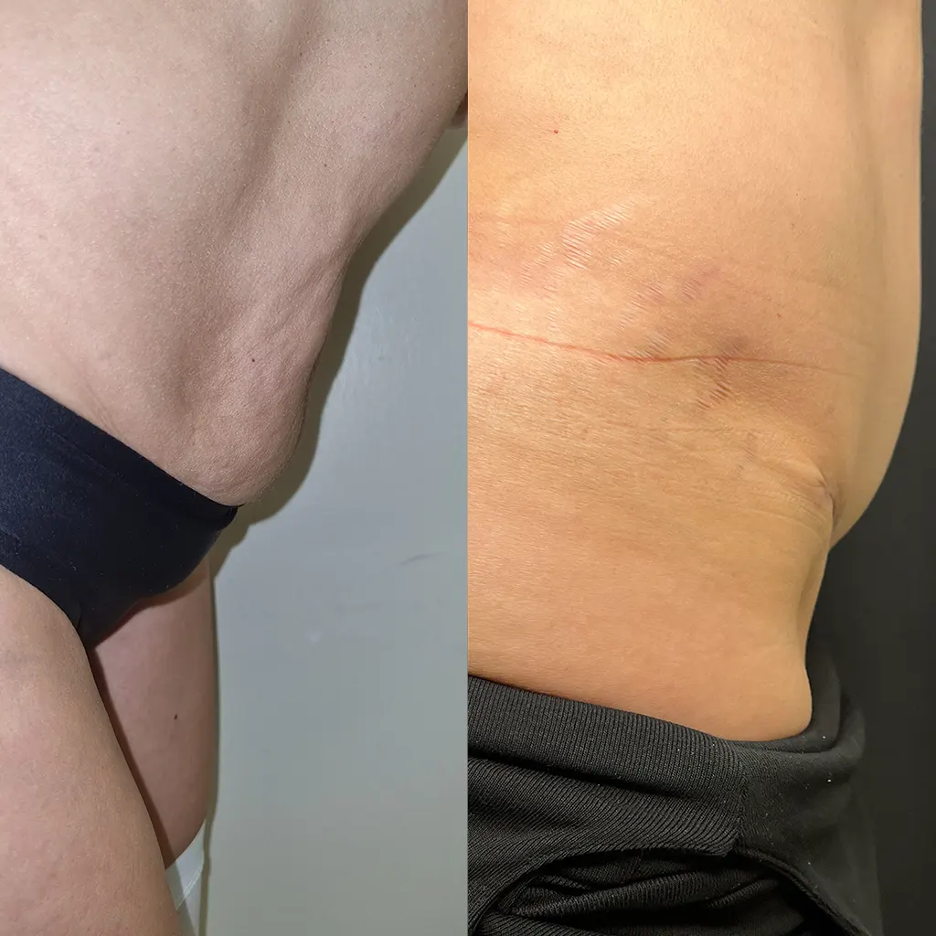 Κοιλιοπλαστική – Πλαστική Κοιλιάς μέσα από αληθινές φωτογραφίες Πριν και Μετά