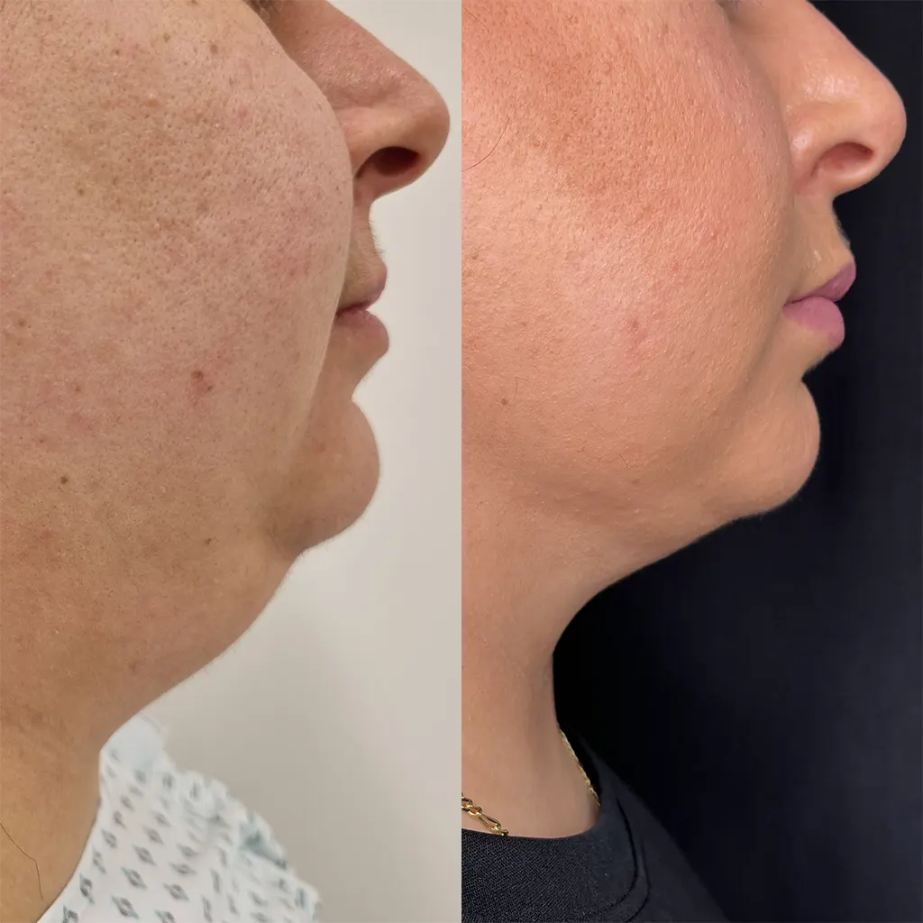 Λιποαναρρόφηση – Λιπογλυπτική μέσα από αληθινές φωτογραφίες Πριν και Μετά