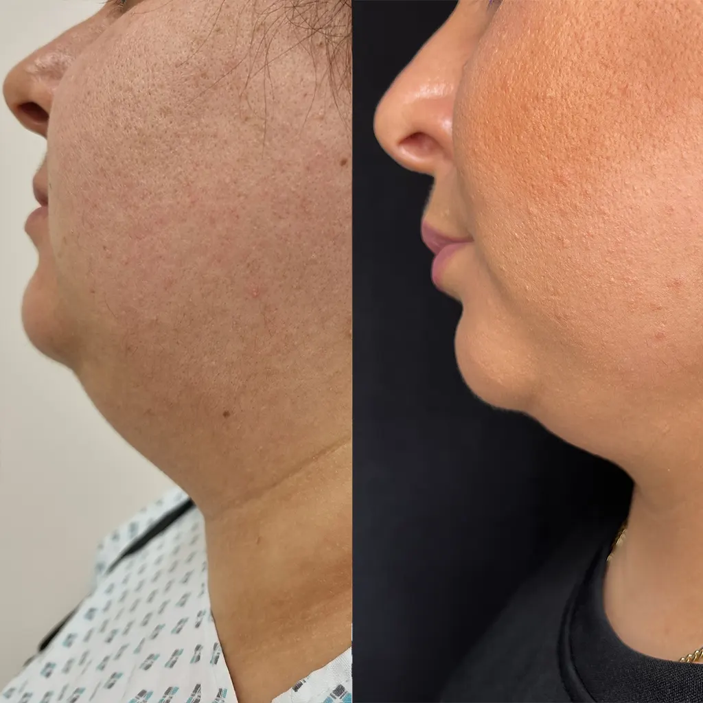 Λιποαναρρόφηση – Λιπογλυπτική μέσα από αληθινές φωτογραφίες Πριν και Μετά