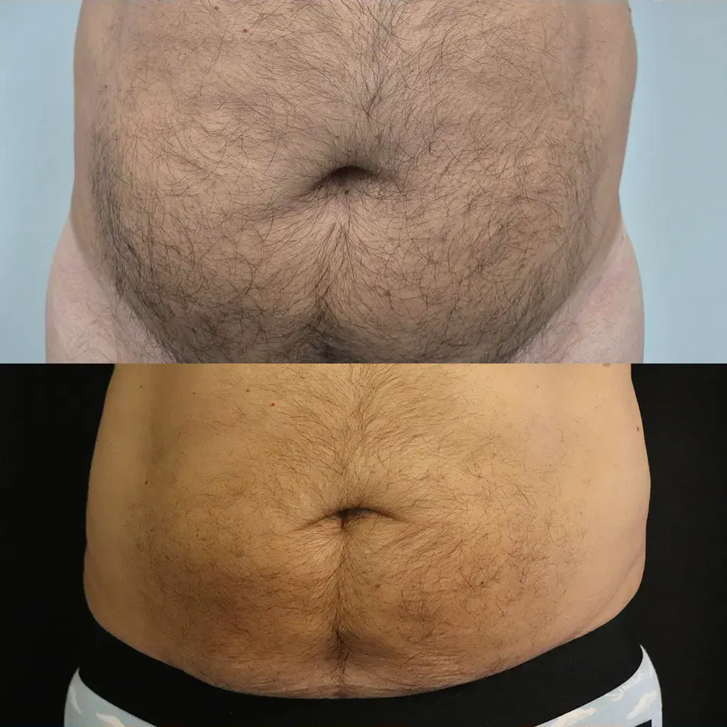 Λιποαναρρόφηση – Λιπογλυπτική μέσα από αληθινές φωτογραφίες Πριν και Μετά