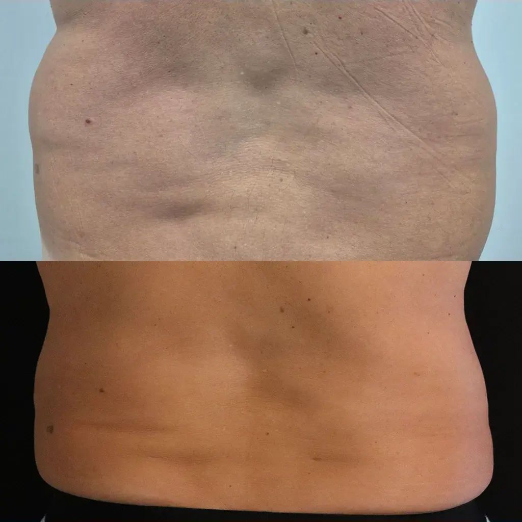 Λιποαναρρόφηση – Λιπογλυπτική μέσα από αληθινές φωτογραφίες Πριν και Μετά