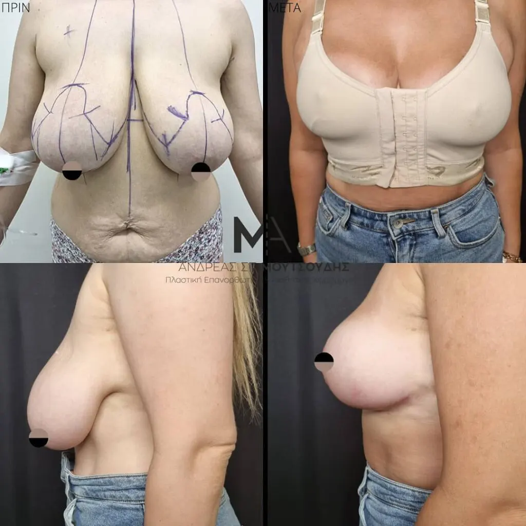 Μείωση Στήθους Πριν και Μετά