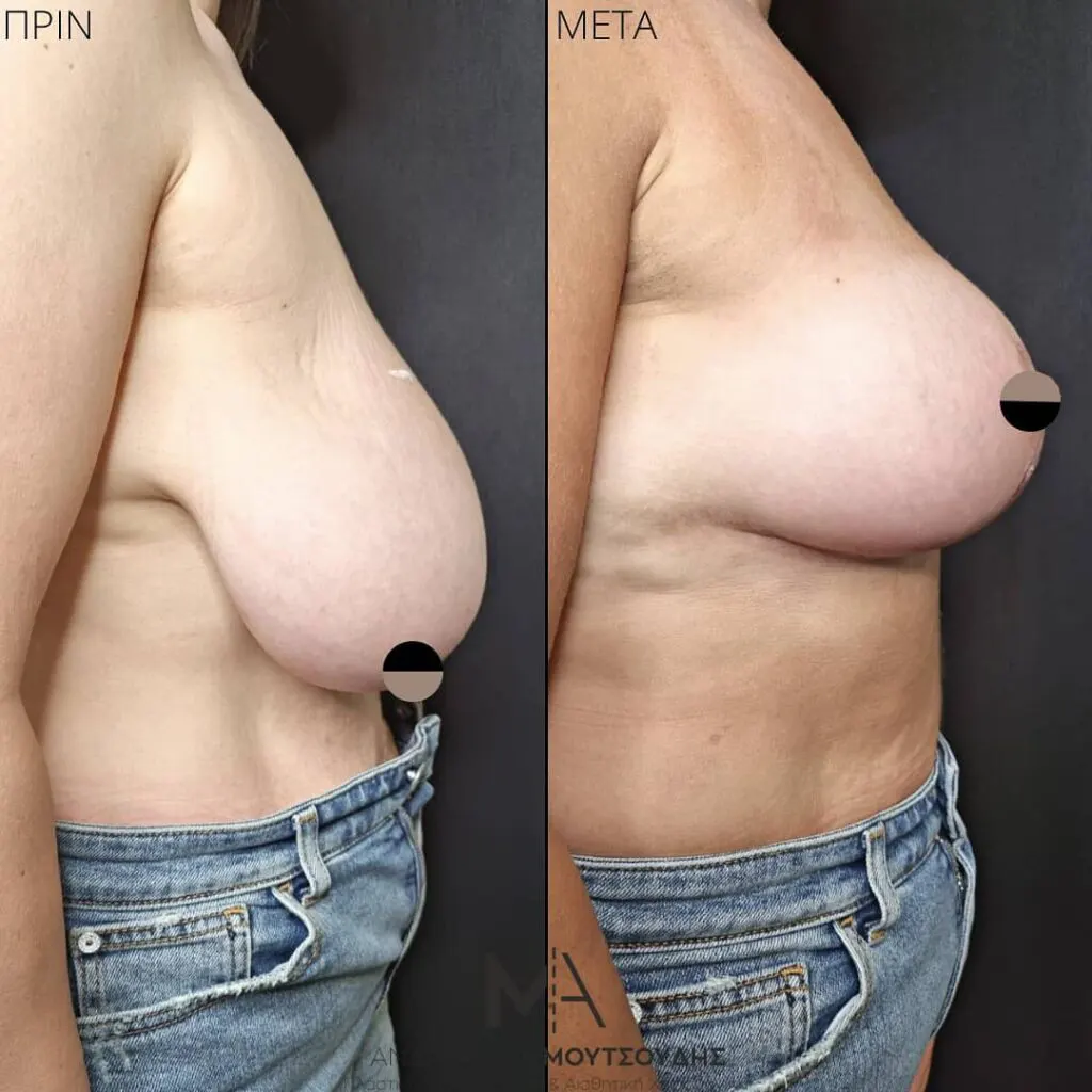Μείωση Στήθους Πριν και Μετά