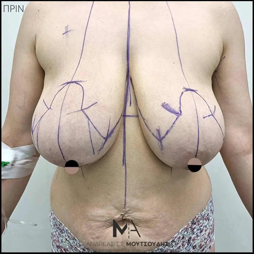 Μείωση Στήθους Πριν και Μετά