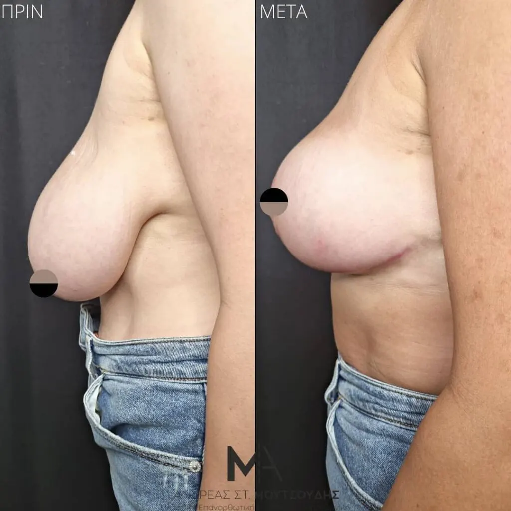 Μείωση Στήθους Πριν και Μετά