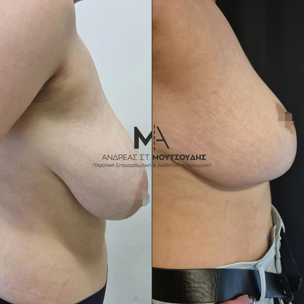 Μείωση Στήθους Πριν και Μετά