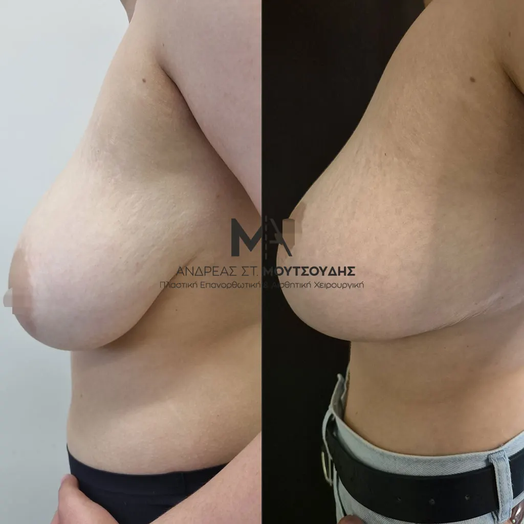 Μείωση Στήθους Πριν και Μετά