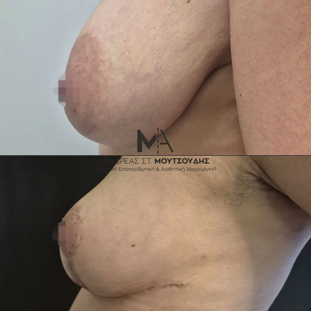 Μείωση Στήθους Πριν και Μετά