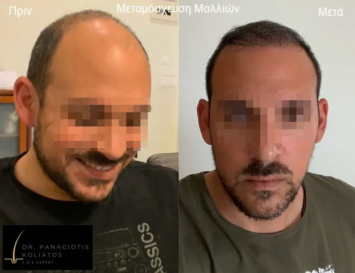 Μεταμόσχευση Μαλλιών μέσα από αληθινές φωτογραφίες Πριν και Μετά