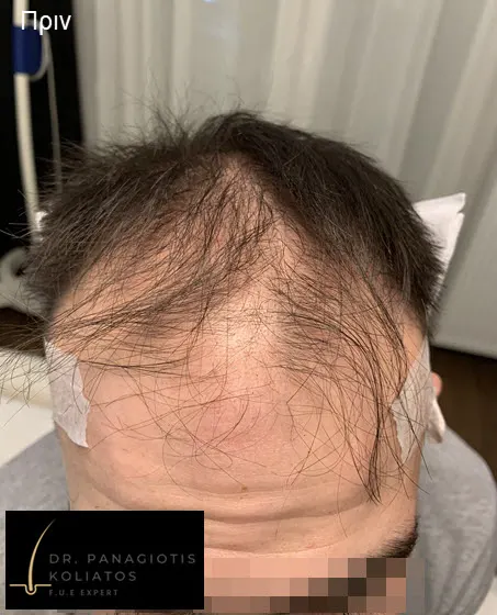 Μεταμόσχευση Μαλλιών μέσα από αληθινές φωτογραφίες Πριν και Μετά