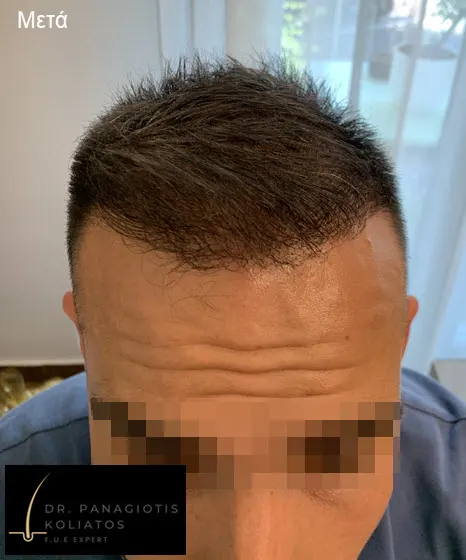 Μεταμόσχευση Μαλλιών μέσα από αληθινές φωτογραφίες Πριν και Μετά