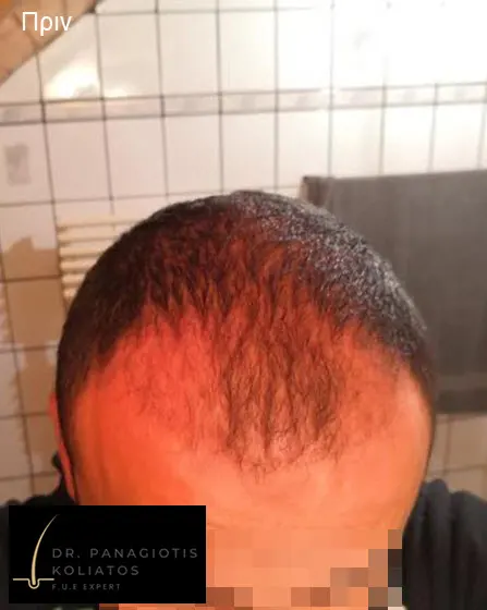 Μεταμόσχευση Μαλλιών μέσα από αληθινές φωτογραφίες Πριν και Μετά