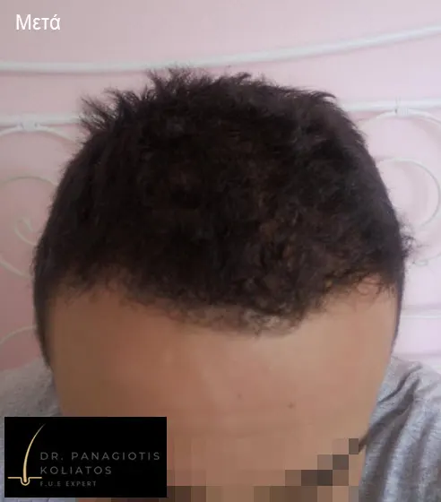 Μεταμόσχευση Μαλλιών μέσα από αληθινές φωτογραφίες Πριν και Μετά