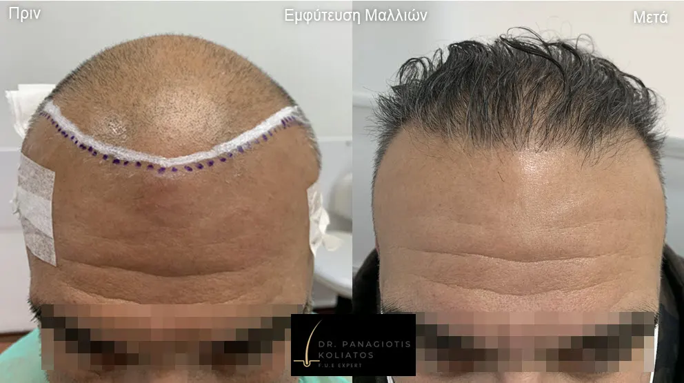 Μεταμόσχευση Μαλλιών μέσα από αληθινές φωτογραφίες Πριν και Μετά