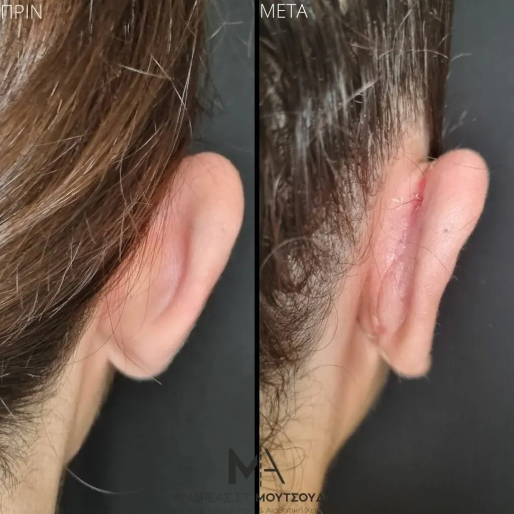 Ωτοπλαστική αληθινές φωτογραφίες Πριν και Μετά