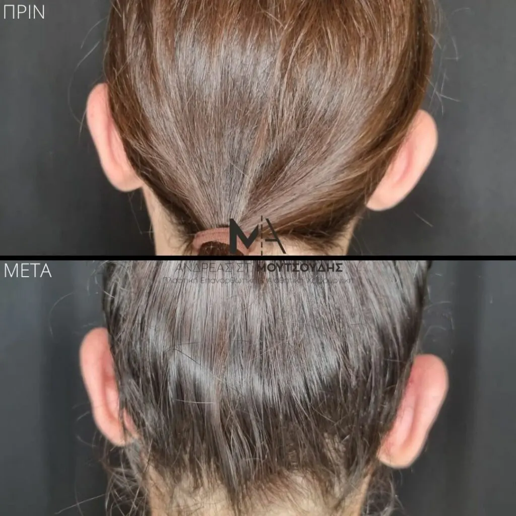 Ωτοπλαστική αληθινές φωτογραφίες Πριν και Μετά