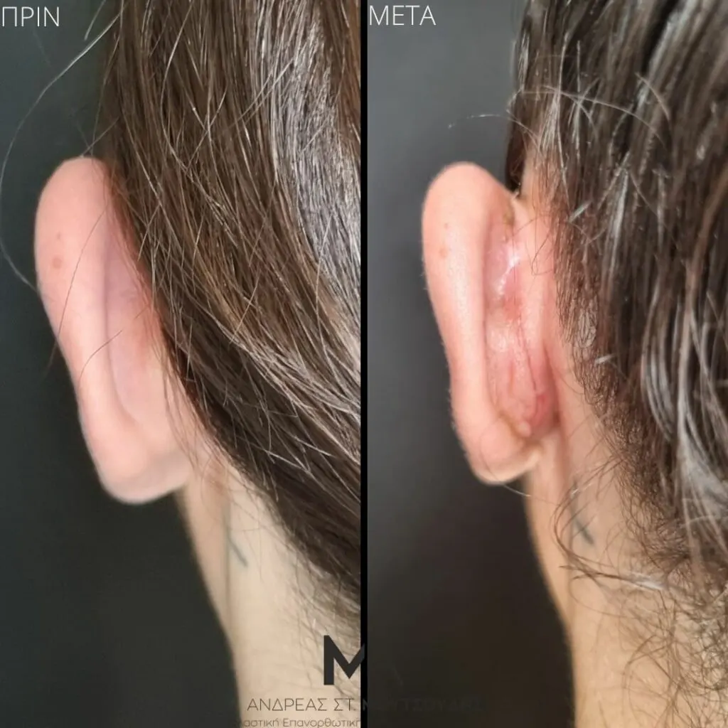 Ωτοπλαστική αληθινές φωτογραφίες Πριν και Μετά