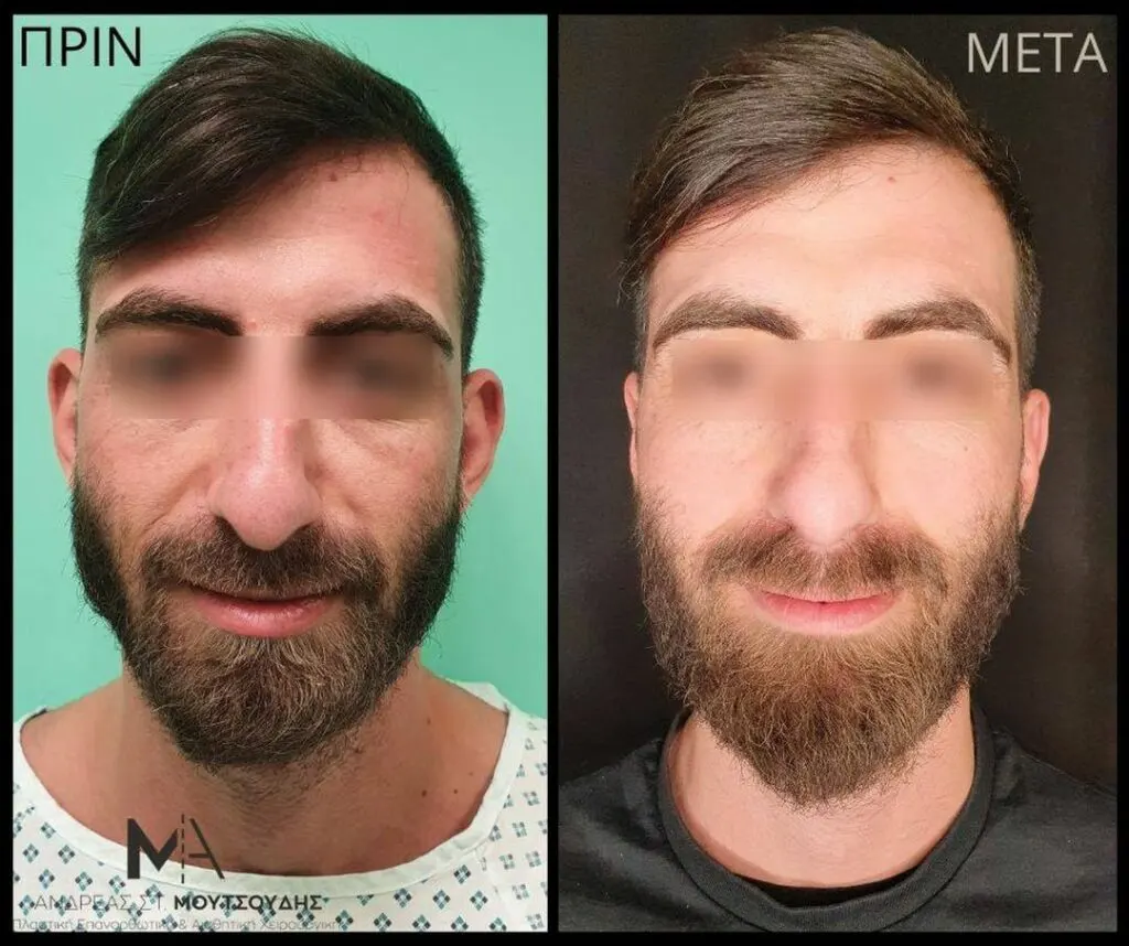 Ωτοπλαστική αληθινές φωτογραφίες Πριν και Μετά