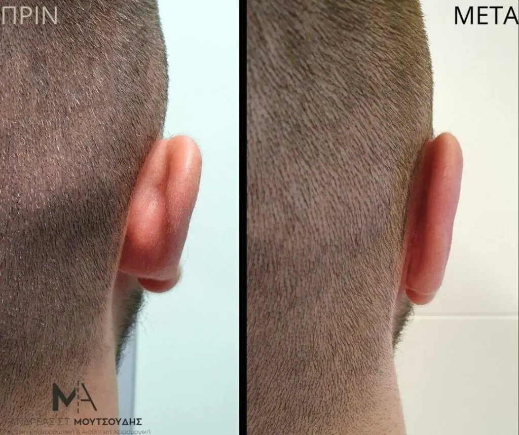 Ωτοπλαστική αληθινές φωτογραφίες Πριν και Μετά