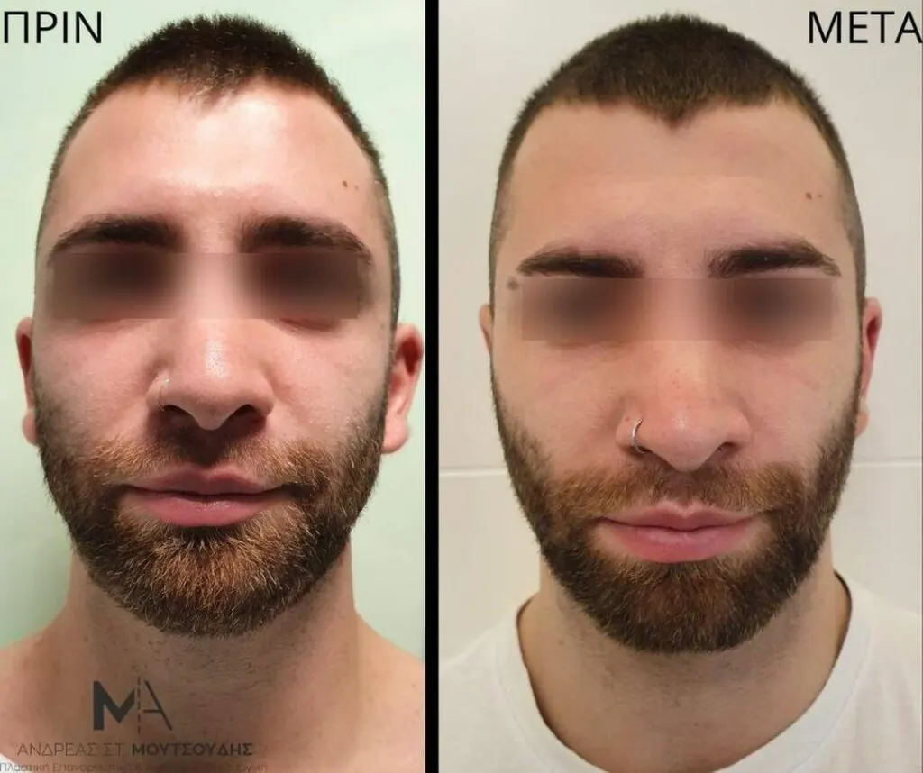 Ωτοπλαστική αληθινές φωτογραφίες Πριν και Μετά