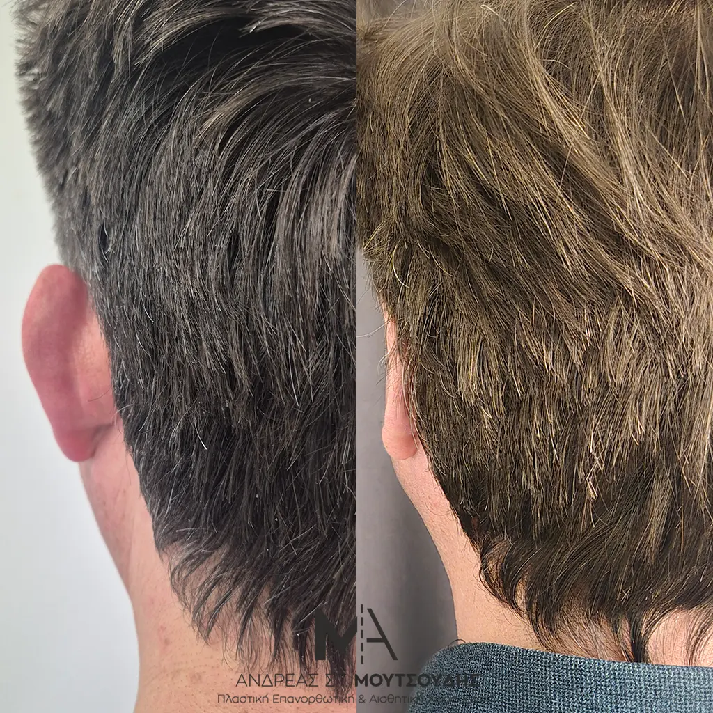 Ωτοπλαστική αληθινές φωτογραφίες Πριν και Μετά