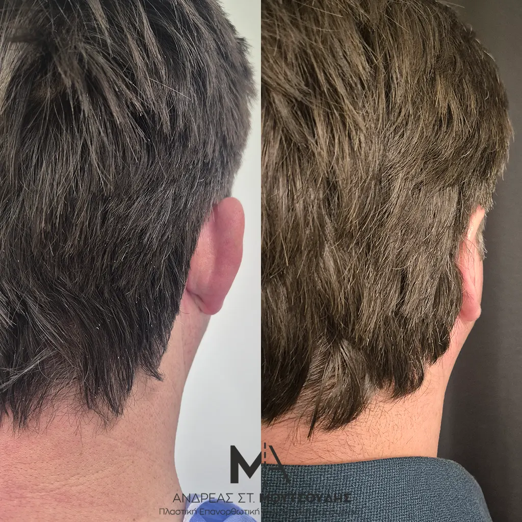 Ωτοπλαστική αληθινές φωτογραφίες Πριν και Μετά