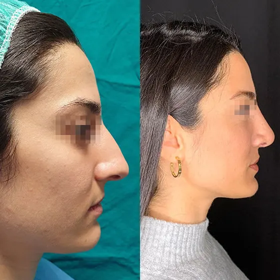 Ρινοπλαστική: Πριν και μετά