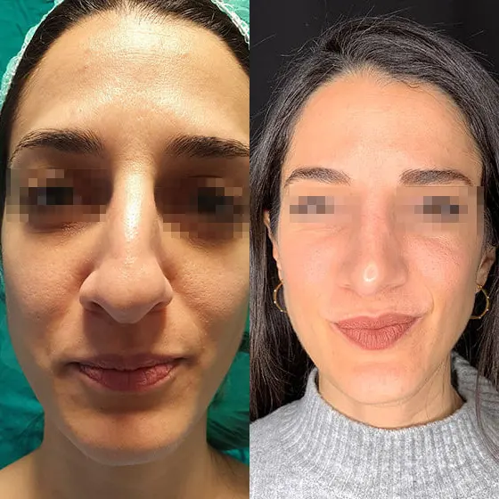 Ρινοπλαστική: Πριν και μετά