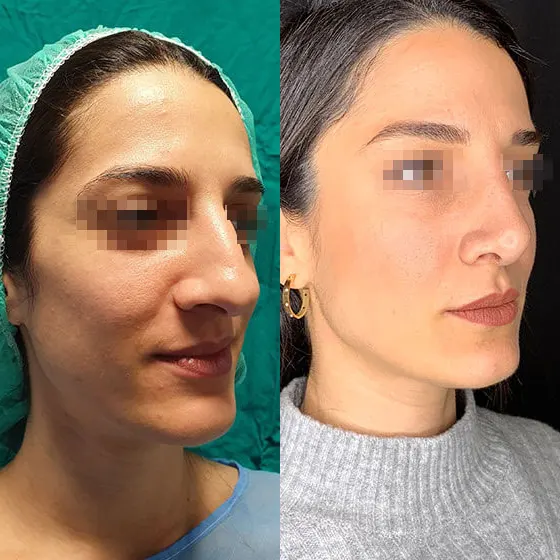 Ρινοπλαστική: Πριν και μετά