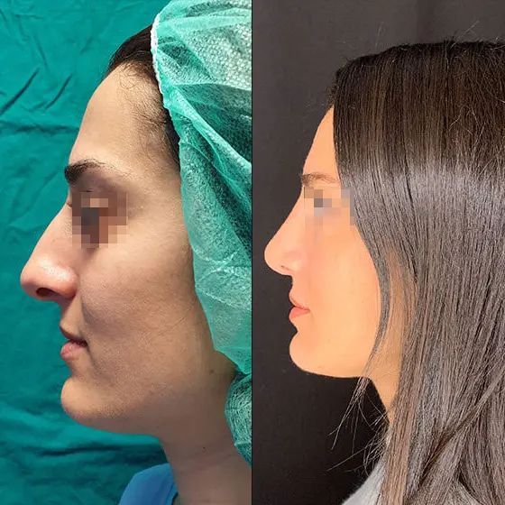 Ρινοπλαστική: Πριν και μετά