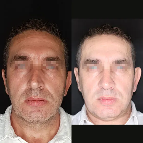 Ρινοπλαστική: Πριν και μετά