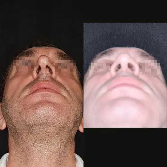 Ρινοπλαστική: Πριν και μετά