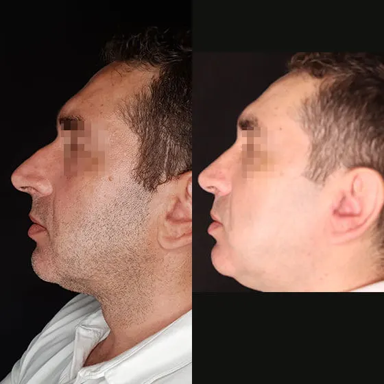 Ρινοπλαστική: Πριν και μετά