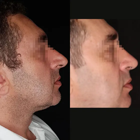 Ρινοπλαστική: Πριν και μετά