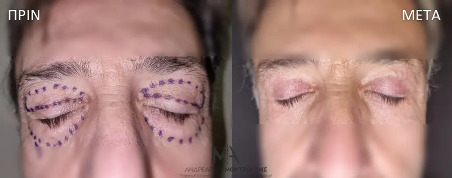 Βλεφαροπλαστική μέσα από αληθινές φωτογραφίες Πριν και Μετά