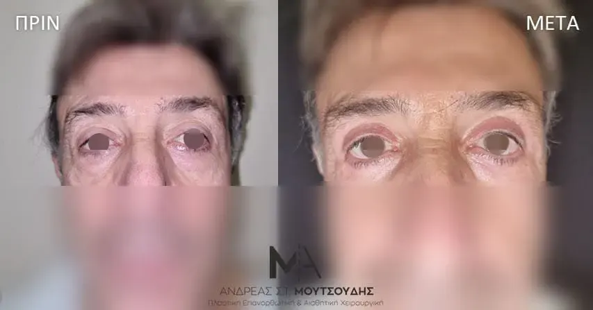 Βλεφαροπλαστική μέσα από αληθινές φωτογραφίες Πριν και Μετά