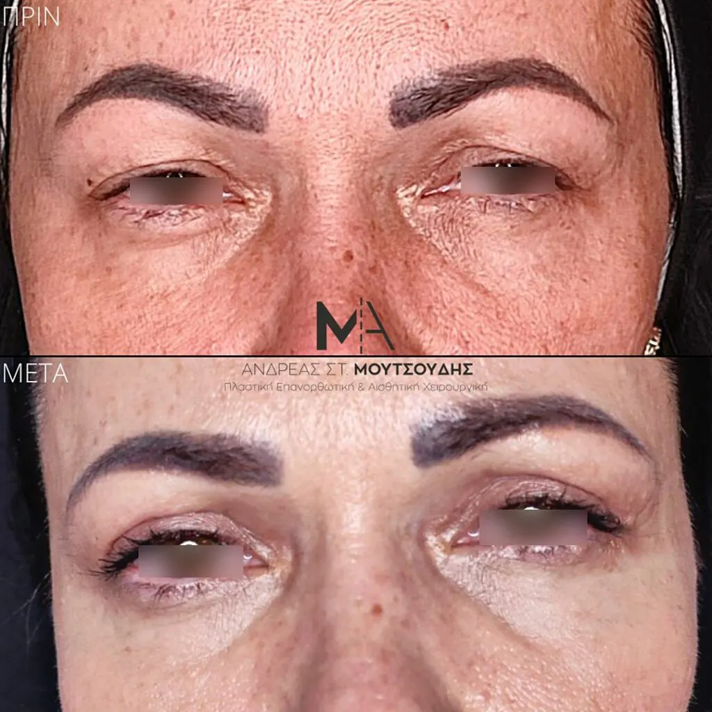 Βλεφαροπλαστική μέσα από αληθινές φωτογραφίες Πριν και Μετά