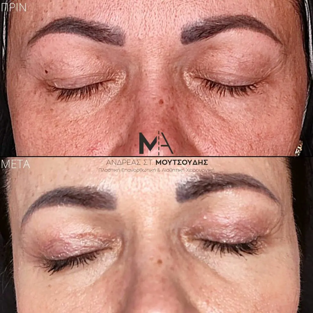 Βλεφαροπλαστική μέσα από αληθινές φωτογραφίες Πριν και Μετά