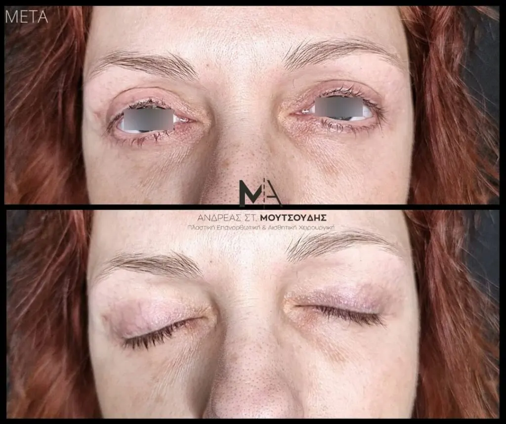 Βλεφαροπλαστική μέσα από αληθινές φωτογραφίες Πριν και Μετά