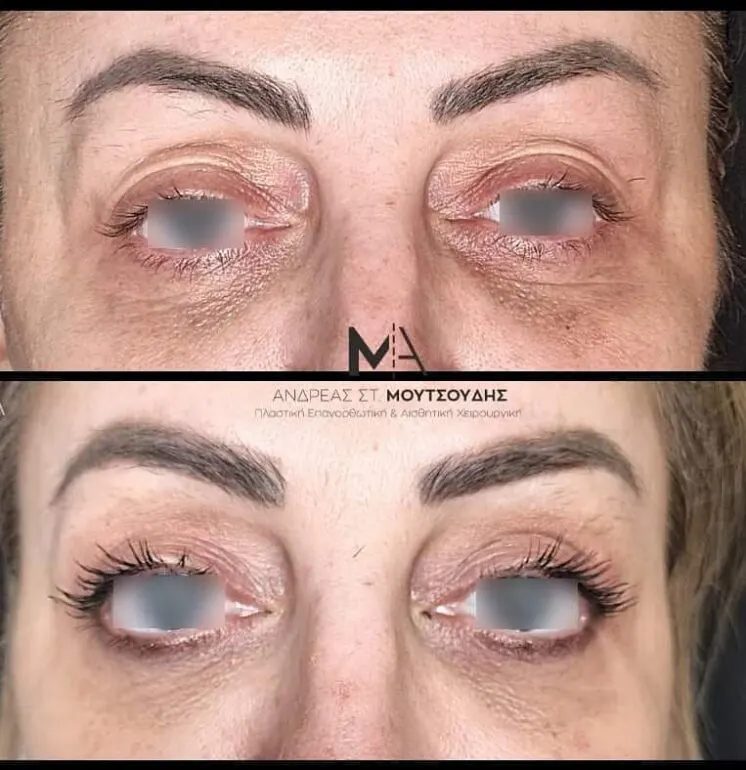 Βλεφαροπλαστική μέσα από αληθινές φωτογραφίες Πριν και Μετά