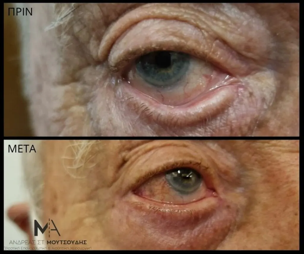 Βλεφαροπλαστική μέσα από αληθινές φωτογραφίες Πριν και Μετά