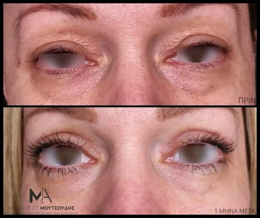 Βλεφαροπλαστική μέσα από αληθινές φωτογραφίες Πριν και Μετά