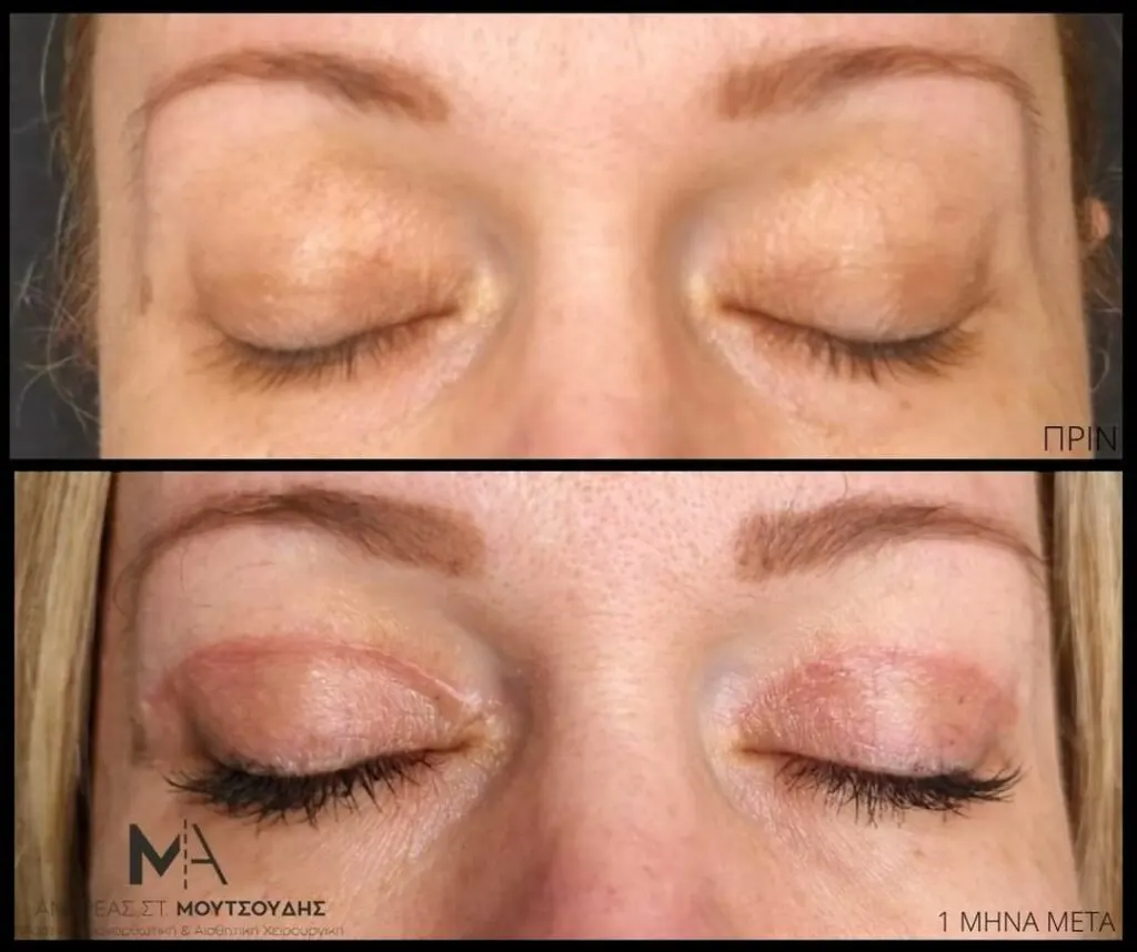 Βλεφαροπλαστική μέσα από αληθινές φωτογραφίες Πριν και Μετά
