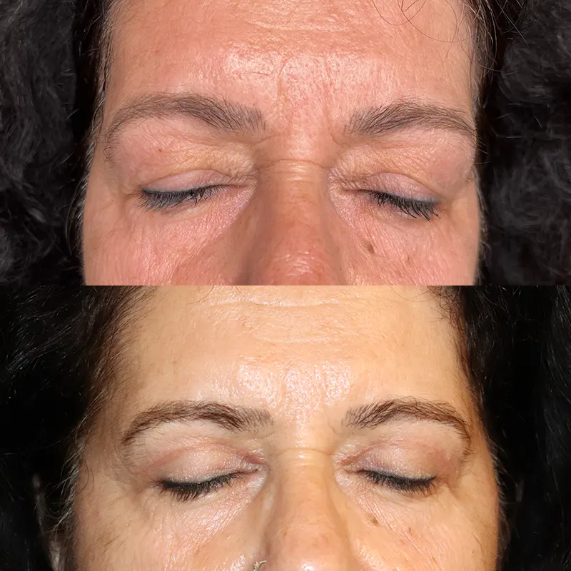 Βλεφαροπλαστική μέσα από αληθινές φωτογραφίες Πριν και Μετά