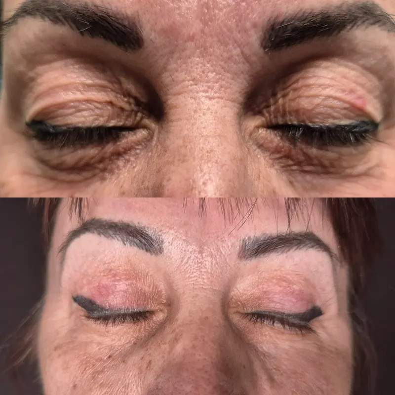 Βλεφαροπλαστική μέσα από αληθινές φωτογραφίες Πριν και Μετά