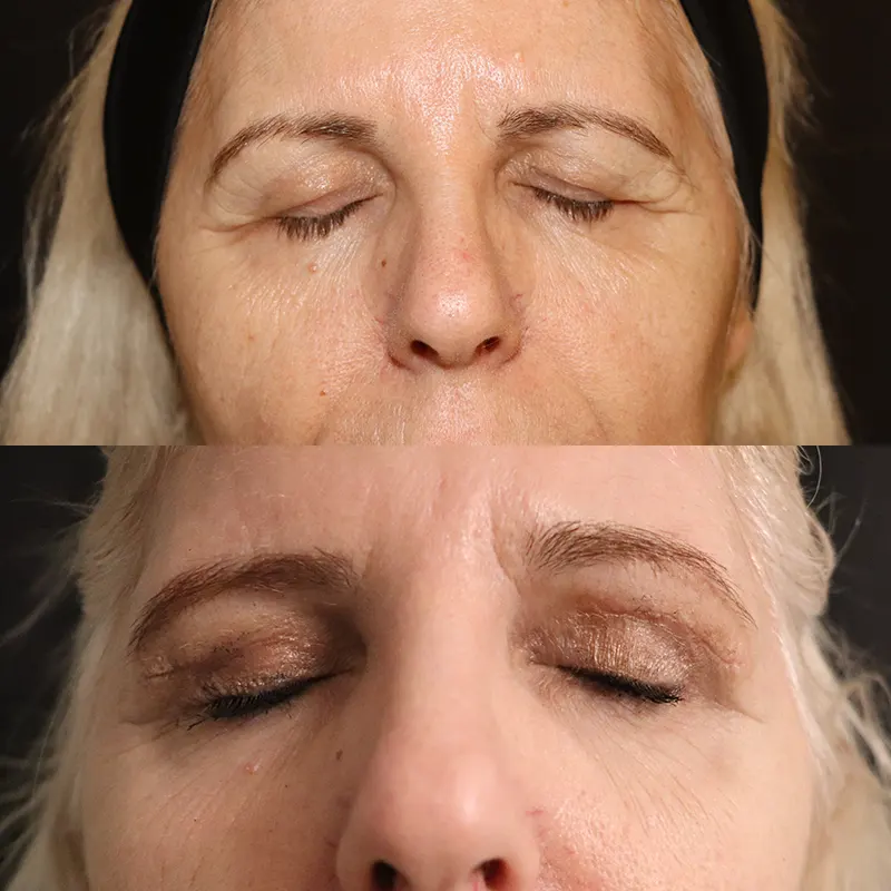 Βλεφαροπλαστική μέσα από αληθινές φωτογραφίες Πριν και Μετά