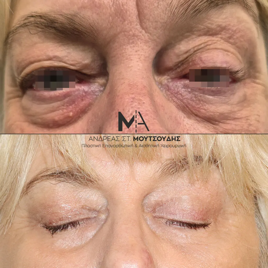 Βλεφαροπλαστική μέσα από αληθινές φωτογραφίες Πριν και Μετά