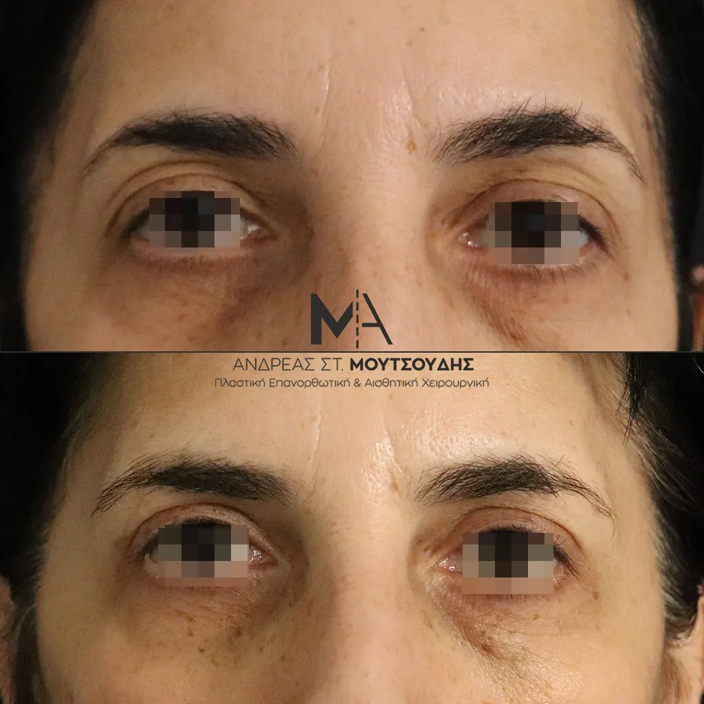 Βλεφαροπλαστική μέσα από αληθινές φωτογραφίες Πριν και Μετά