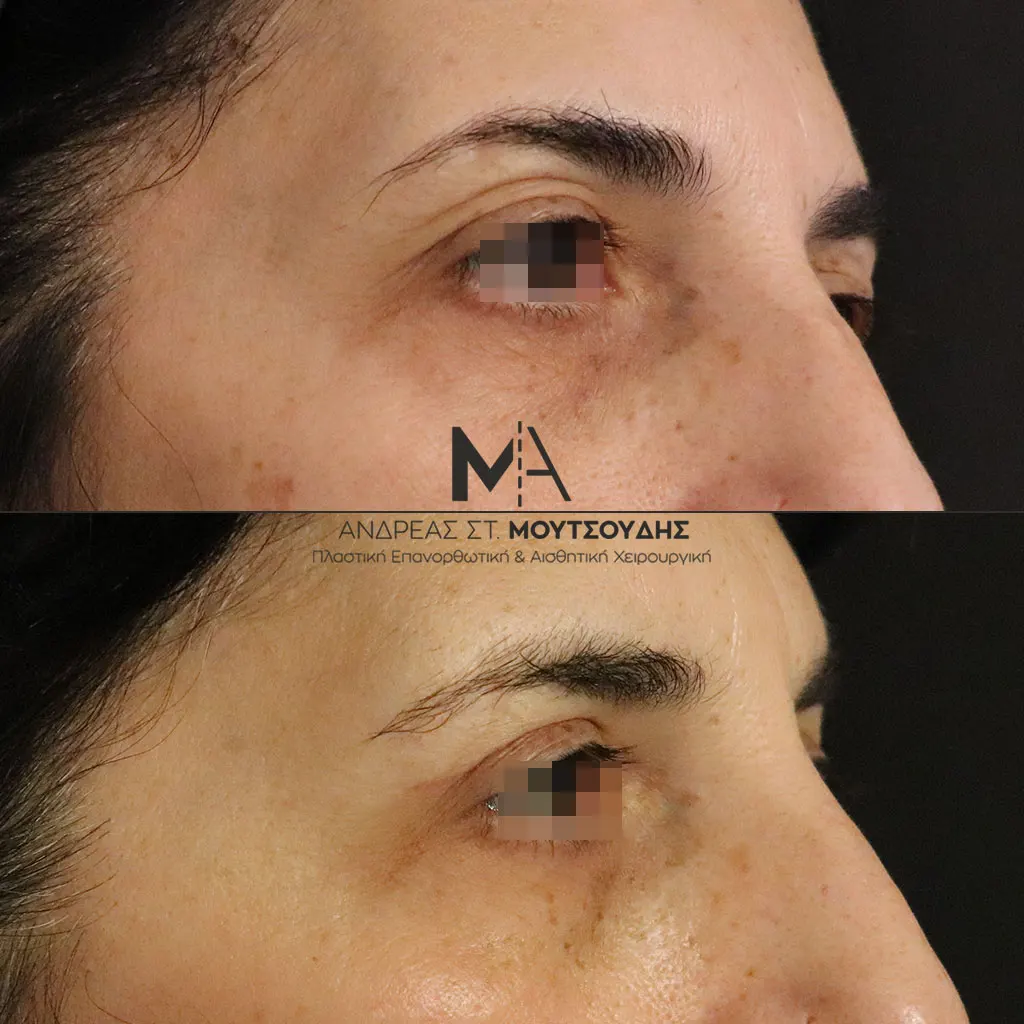 Βλεφαροπλαστική μέσα από αληθινές φωτογραφίες Πριν και Μετά