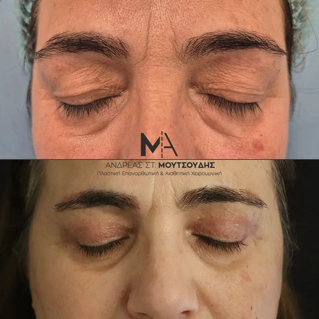 Βλεφαροπλαστική μέσα από αληθινές φωτογραφίες Πριν και Μετά